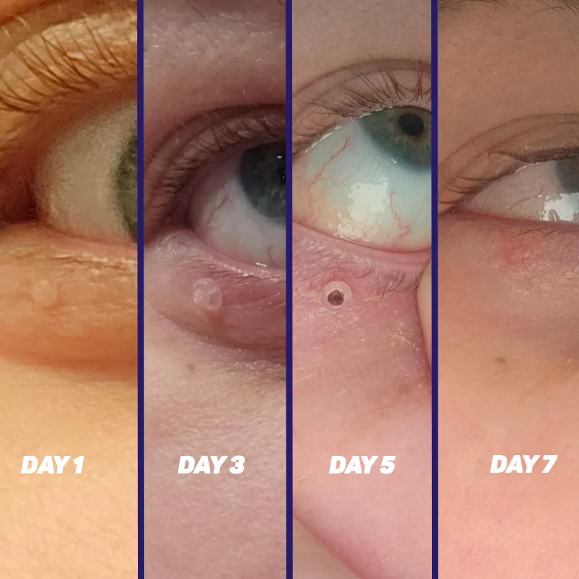 TagPal Skin Tag Remover